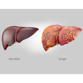 Xơ gan: Nguyên nhân, triệu chứng, chẩn đoán và cách điều trị