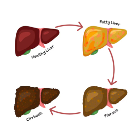 Xơ gan có mấy giai đoạn? Cách phòng ngừa bệnh xơ gan