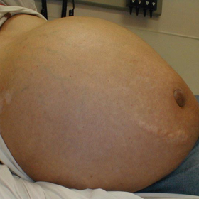 Xơ gan cổ trướng có gây nguy hiểm không? Biện pháp phòng ngừa