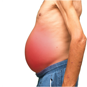 Xơ gan cổ trướng: Phương pháp chữa bệnh giai đoạn cuối