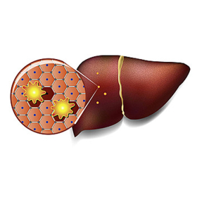 Xơ gan còn bù là gì? Những điều bạn cần biết