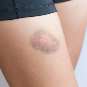 Xơ gan độ 3 (F3): Dấu hiệu, biến chứng và cách kiểm soát