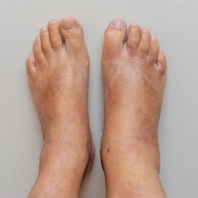 Xơ gan độ 4: 5 triệu chứng “tiên lượng xấu” cần biết