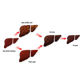 Xơ gan do rượu: Nguyên nhân, triệu chứng và cách phòng ngừa