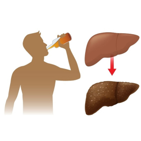 Xơ gan do rượu có chữa được không? Dấu hiệu và phương pháp